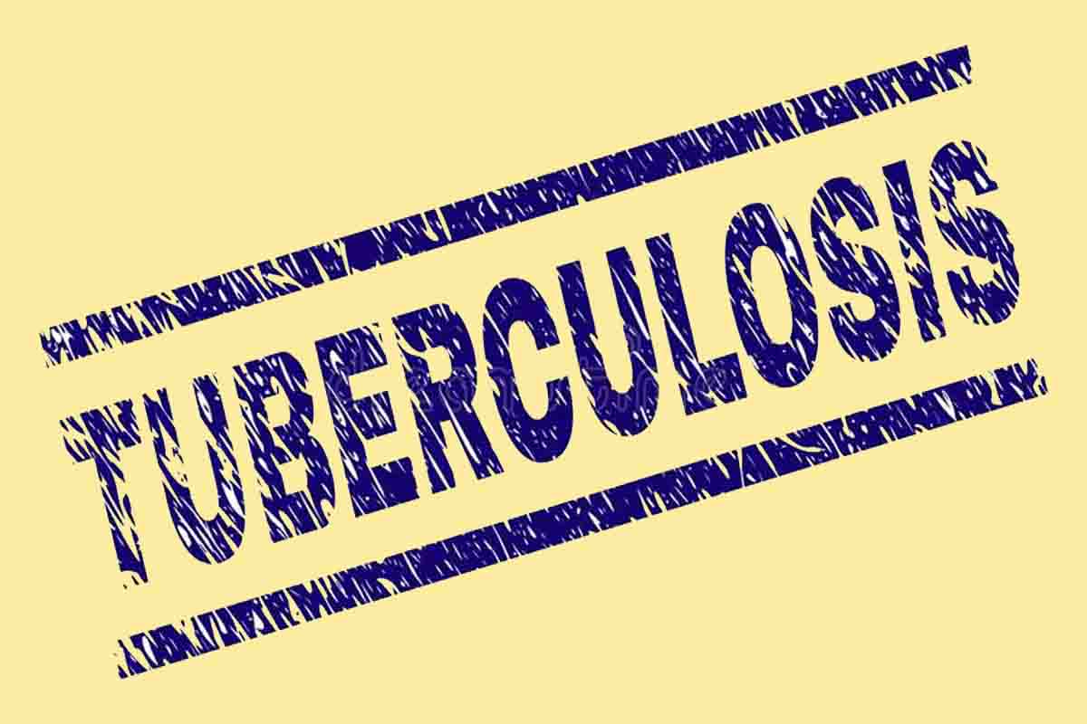 Tuberculosis