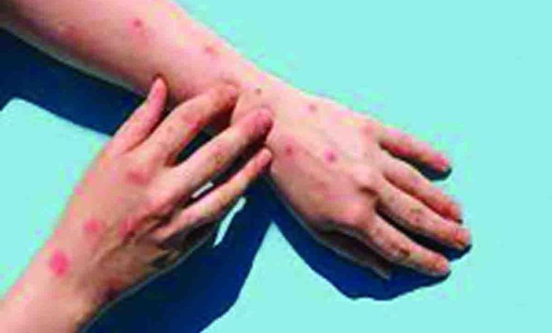 monkeypox