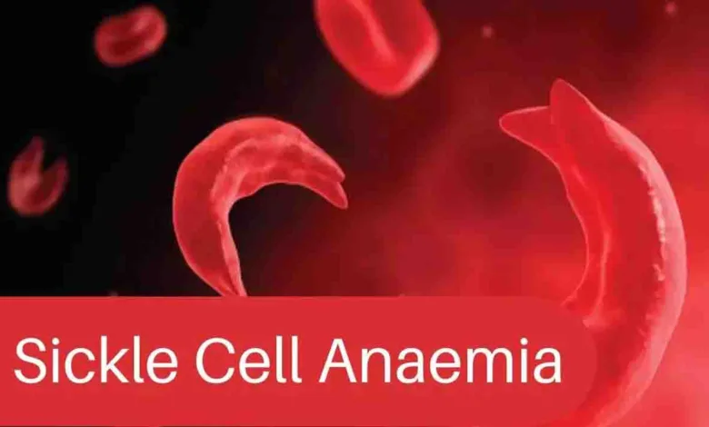 Sickle Cell Disease