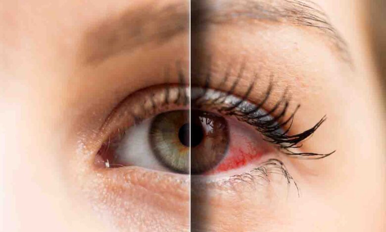 eye infections and dryness