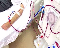 dialysis